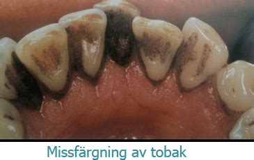 Missfärgade tänder svart
